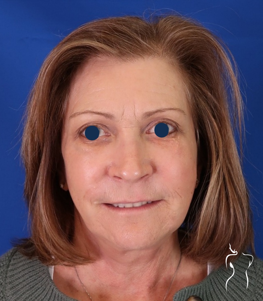 Face & Neck Lift, after — actual patient of Dr. Day