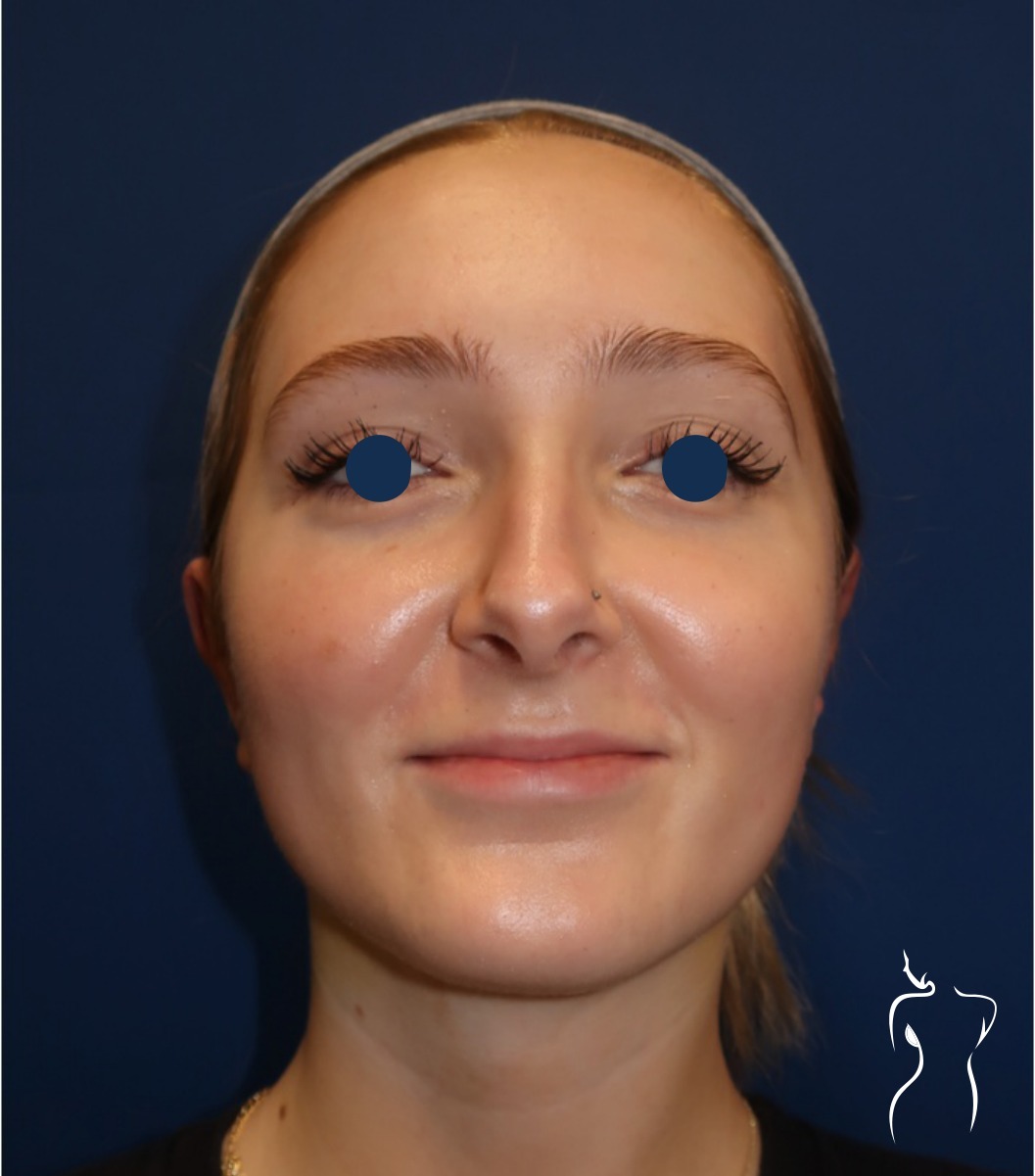Otoplasty, after — actual patient of Dr. Day