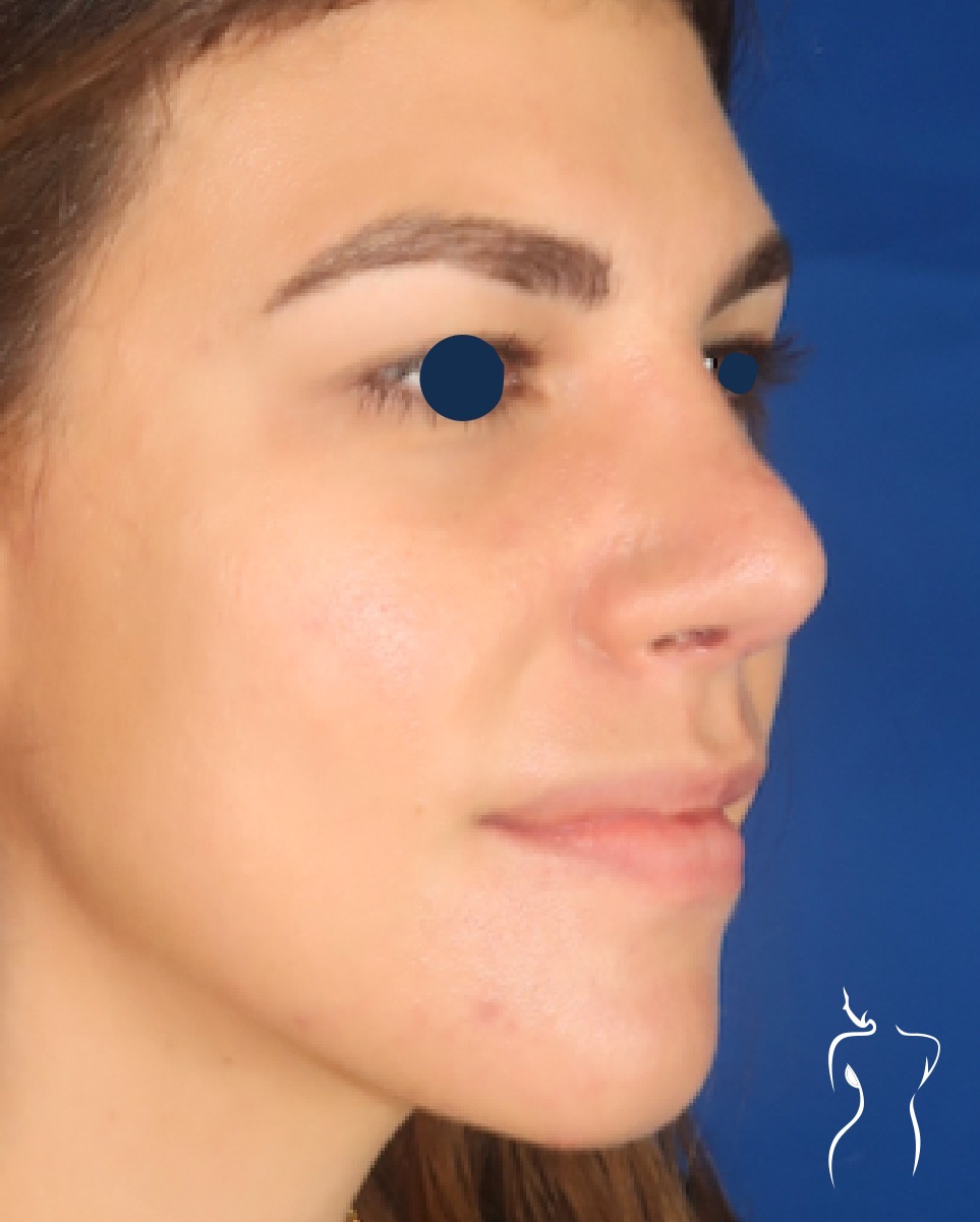 Rhinoplasty, after — actual patient of Dr. Day