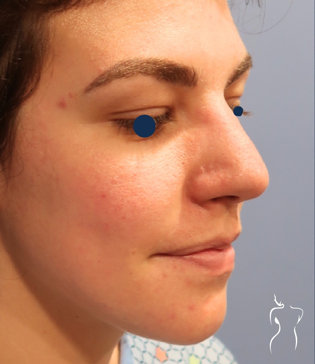 Rhinoplasty, before — actual patient of Dr. Day